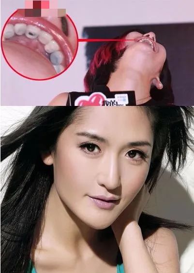 明星牙齿健康揭秘，关注蛀牙与口腔护理的重要性
