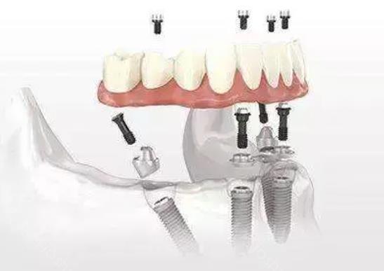 老人全口种植牙价格详解,全方位解析与比较