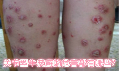 牛皮癣最新治疗方法揭秘,探索最新治疗策略