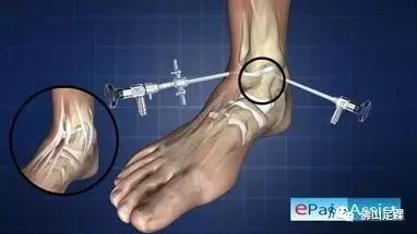 腓炎资讯,最新动态与热点解读