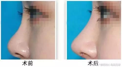 重塑完美鼻型的科技奇迹，最新隆鼻技术突破揭秘